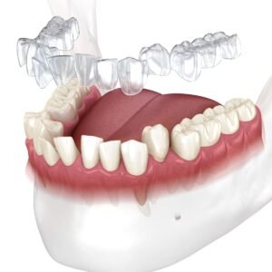 Invisalign are clear aligners